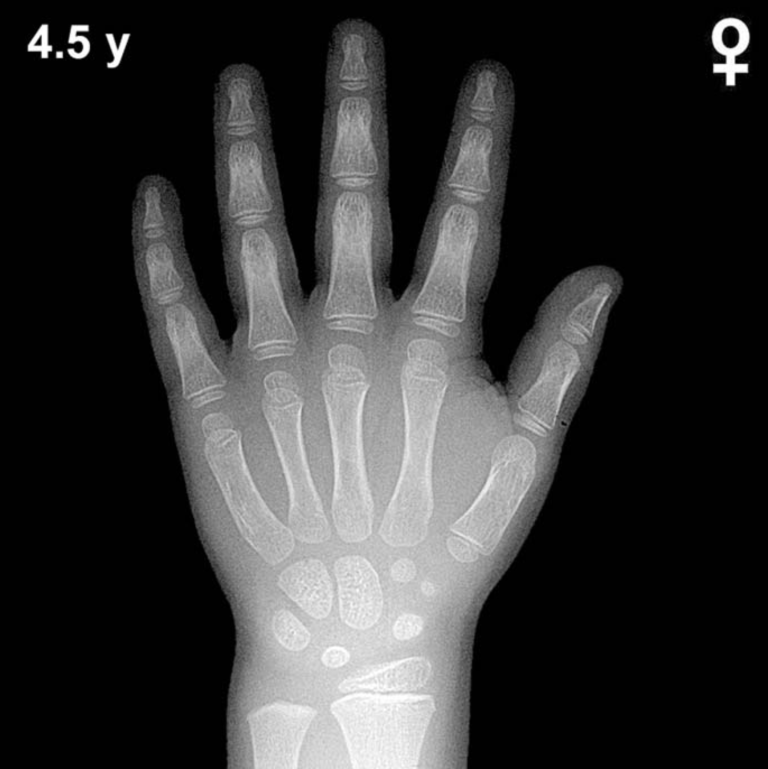 Bone age hand X-ray, girls 4.5 years