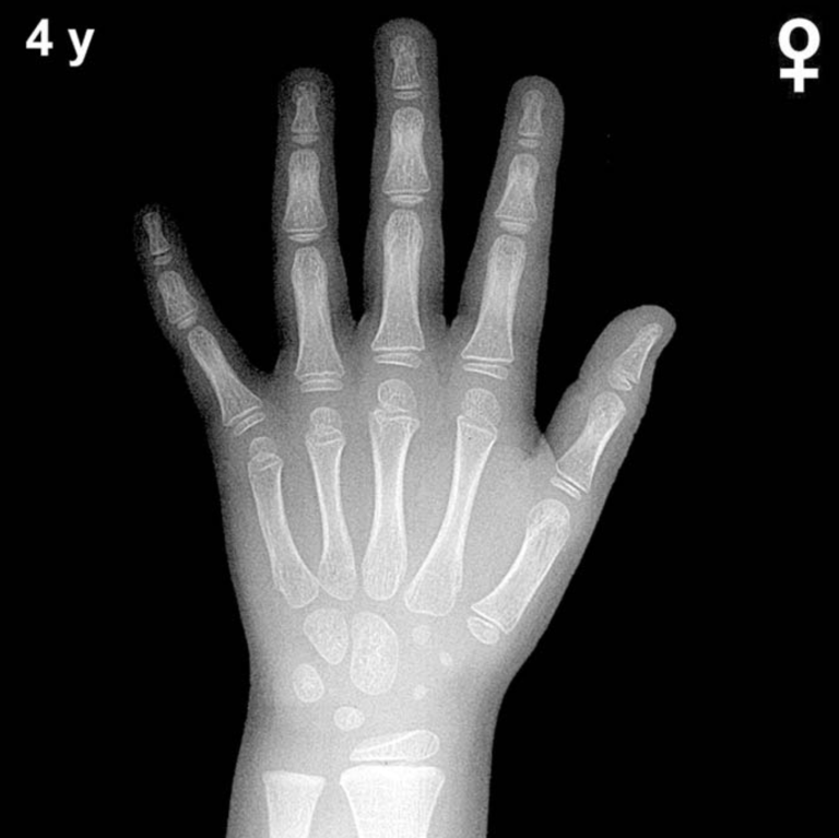 Bone age hand X-ray, girls 4 years
