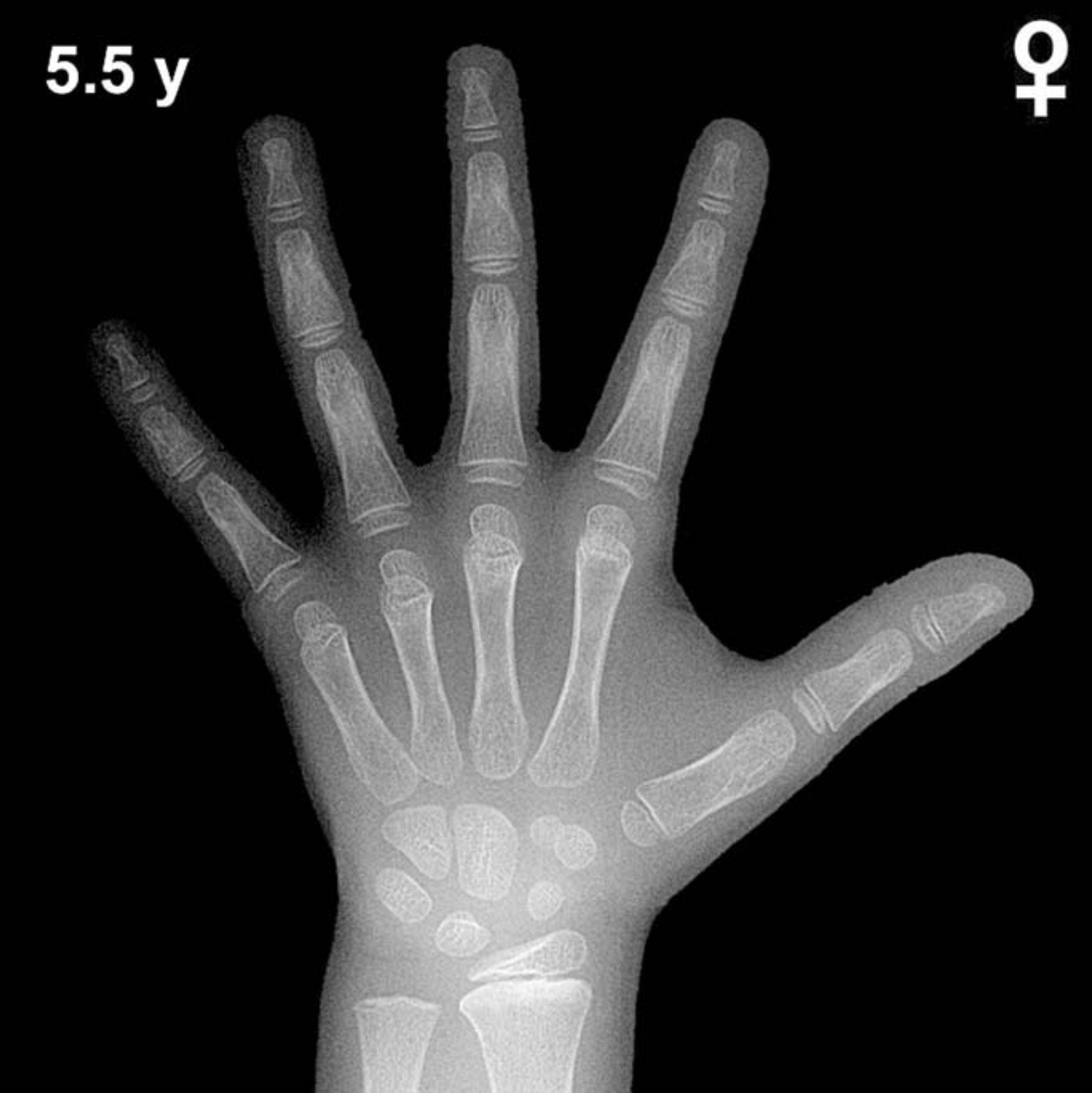 Bone age hand X-ray, girls 5.5 years
