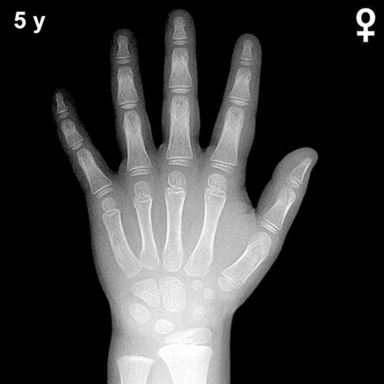 Bone age hand X-ray, girls 5 years