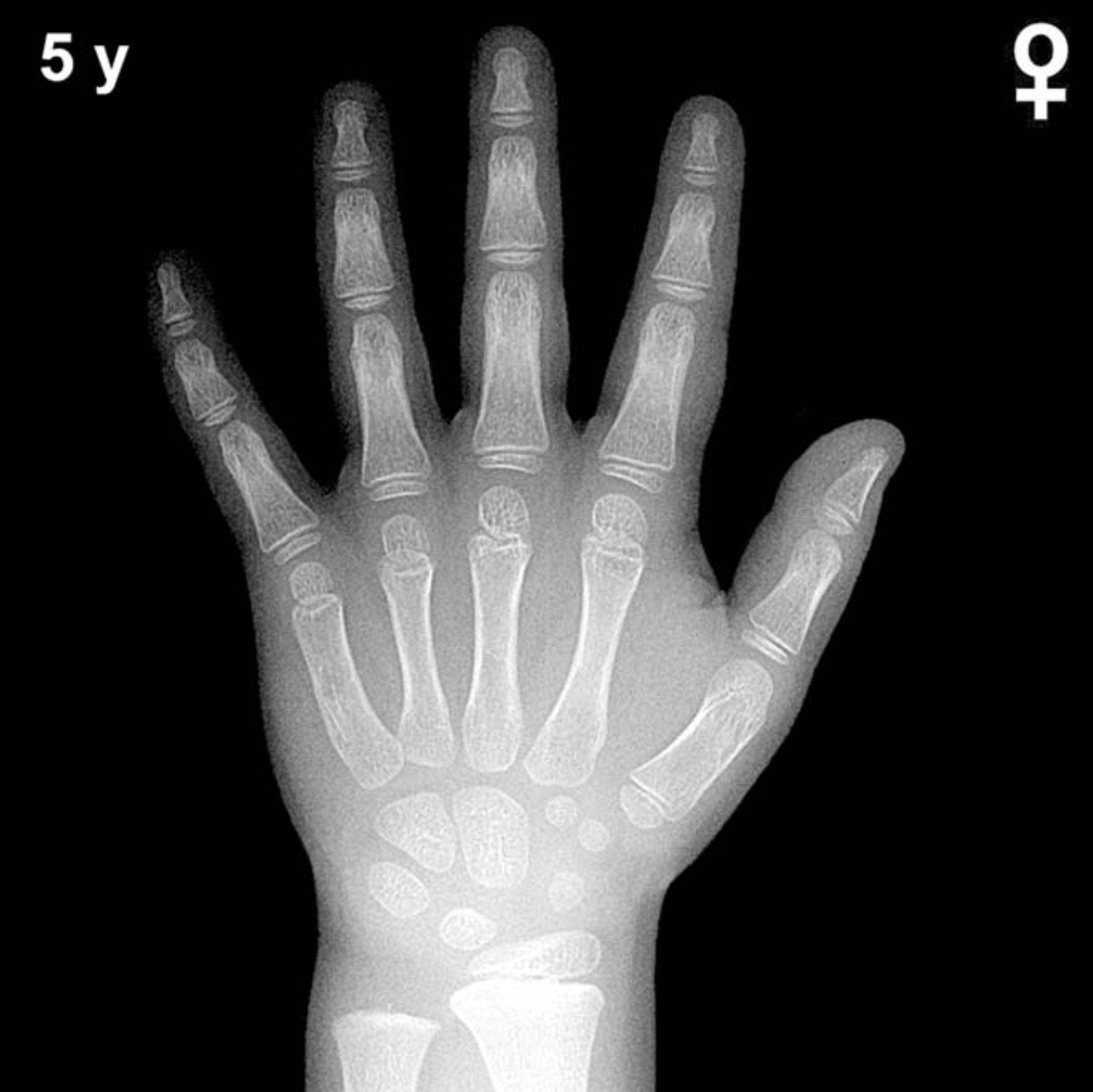 Bone age hand X-ray, girls 5 years