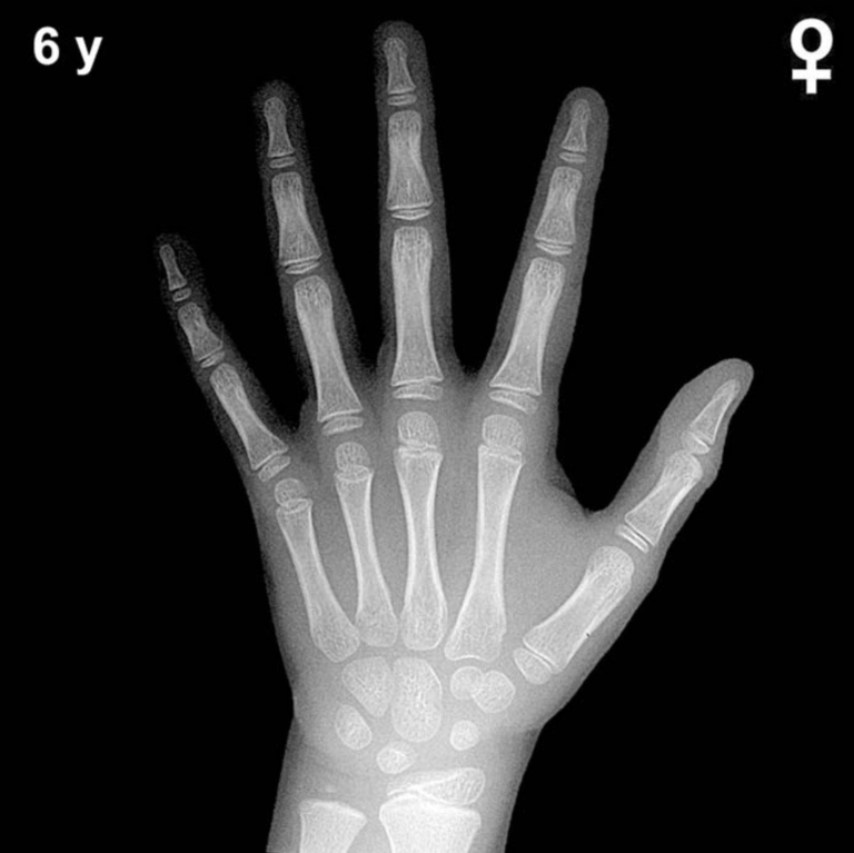 Bone age hand X-ray, girls 6 years