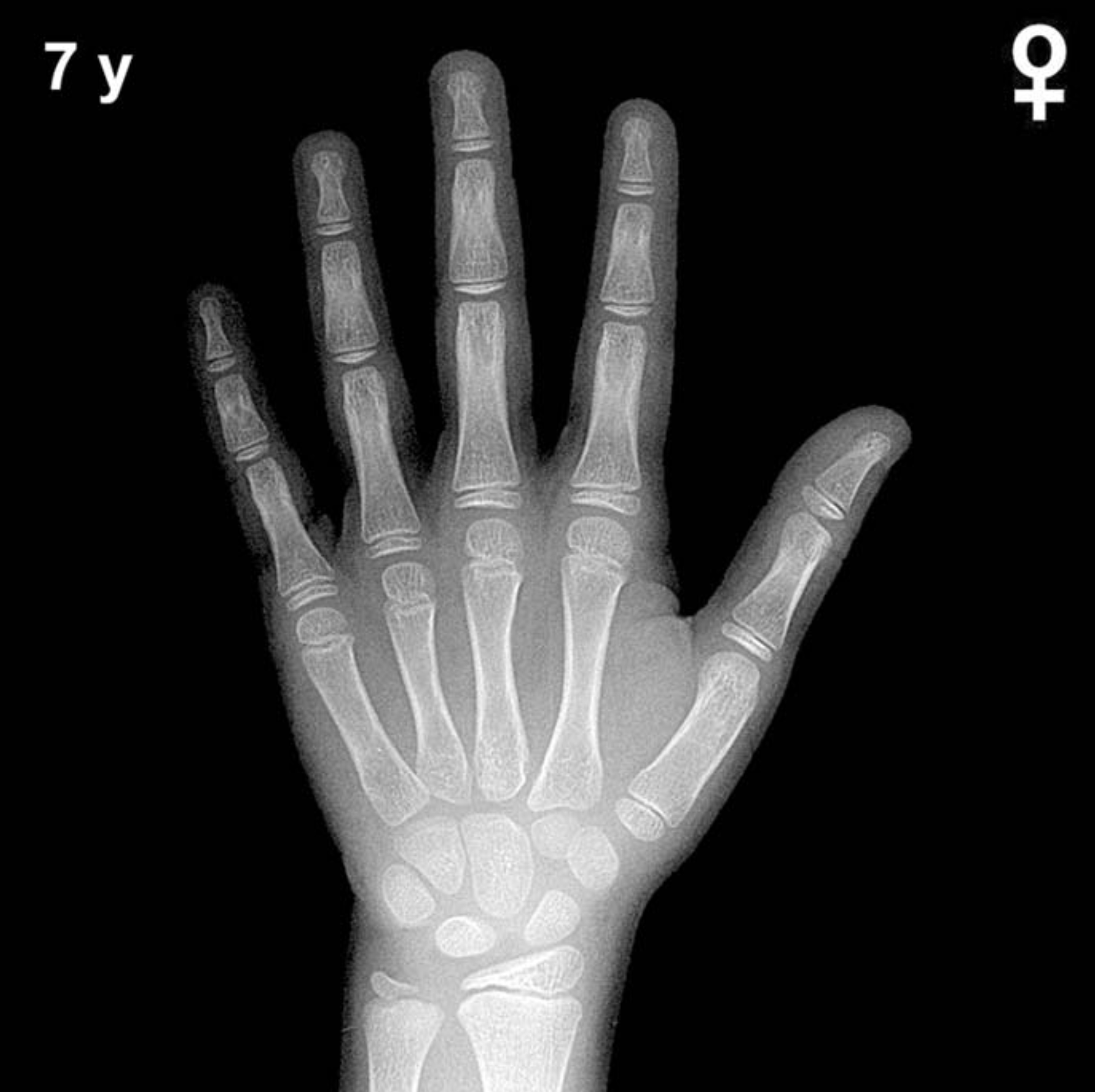 Reference hand and wrist X-ray: girls aged 7 years (Greulich-Pyle).