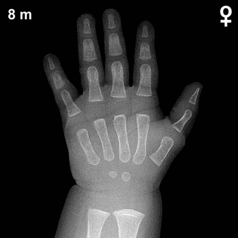 Bone age hand X-ray, girls 8 months