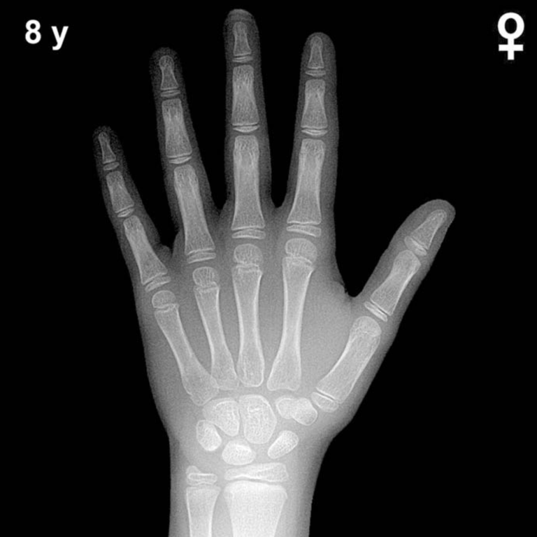 Bone age hand X-ray, girls 8 years
