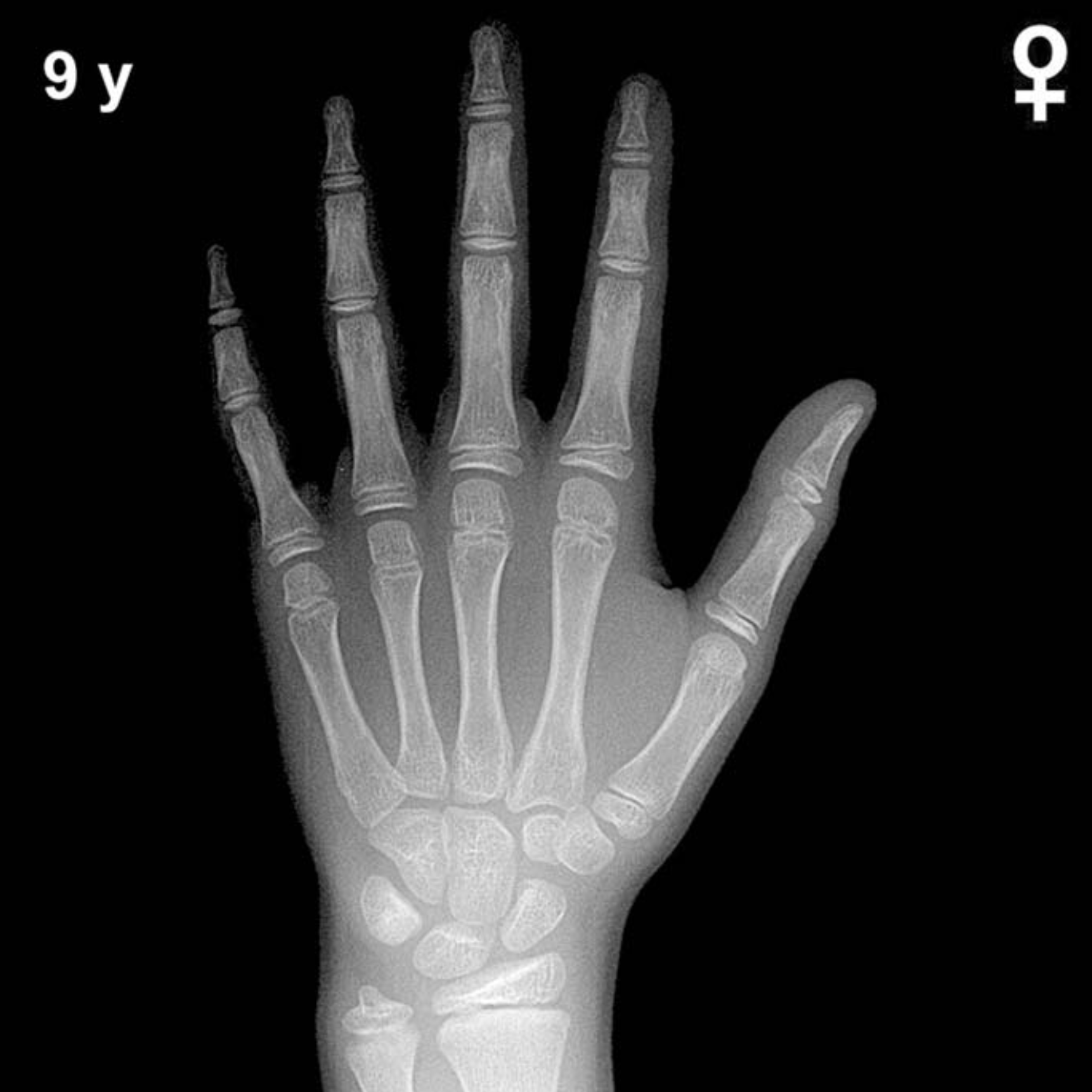 Bone age hand X-ray, girls 9 years